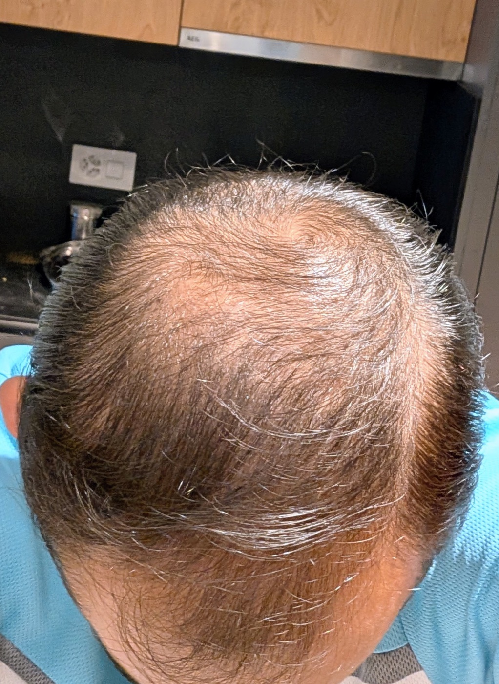 Top-down view of the crown before the hair transplant, showing diffuse thinning around the whorl
