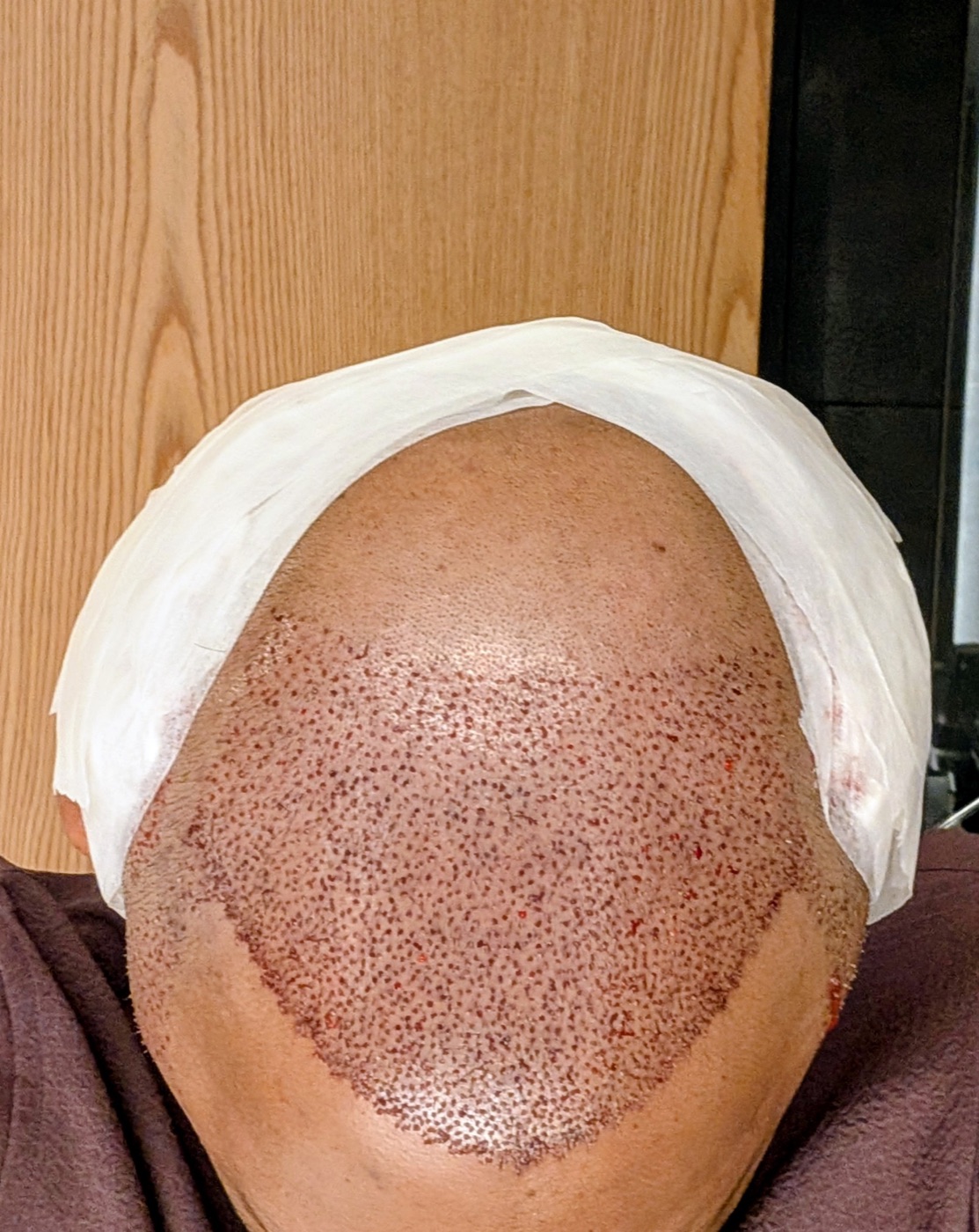 Frontal view of the scalp immediately after the hair transplant, showing 3,200 freshly implanted grafts and a gauze headband