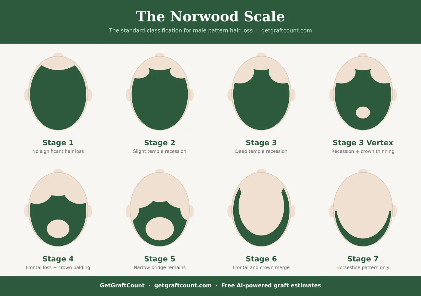 La scala di Norwood illustrata: dallo stadio 1 (nessuna perdita significativa di capelli) allo stadio 7 (solo motivo a ferro di cavallo), che mostra il progressivo arretramento dell'attaccatura e il diradamento del vertice.