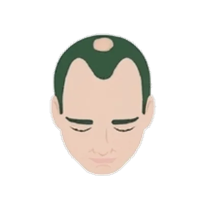 Norwood Stage 4 — frontal loss plus crown balding